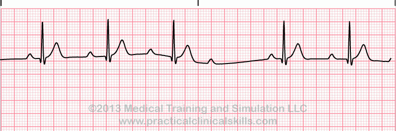 Second Degree Heart Block Type I ECG tracing