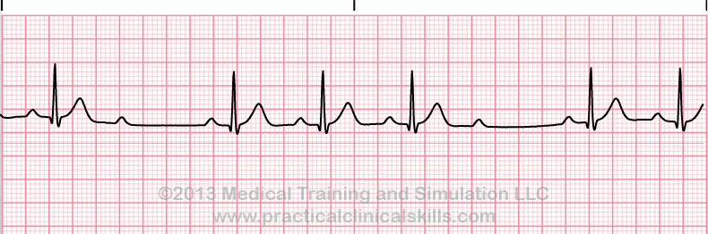 Second Degree Heart Block Type II EKG tracing