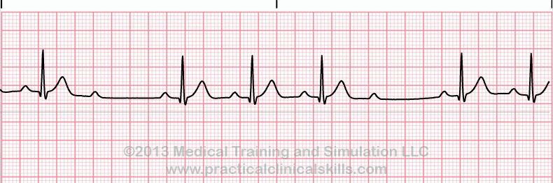 ecg rhythm strip for quiz