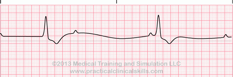 ecg rhythm strip for quiz