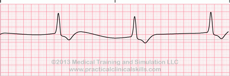 ecg rhythm strip for quiz