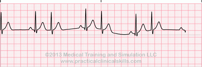 ecg rhythm strip for quiz