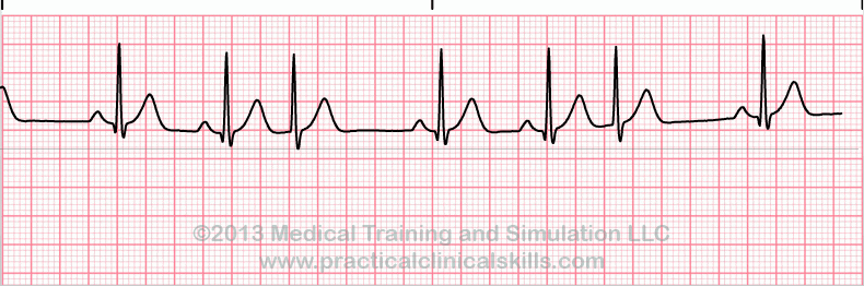 ecg rhythm strip for quiz