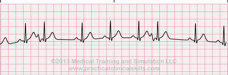 ecg rhythm strip for quiz