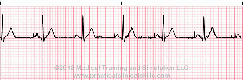 ecg rhythm strip for quiz