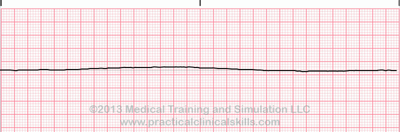 Asystole EKG tracing