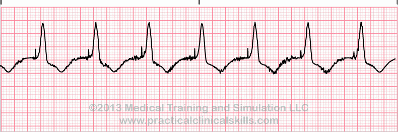 ecg rhythm strip for quiz