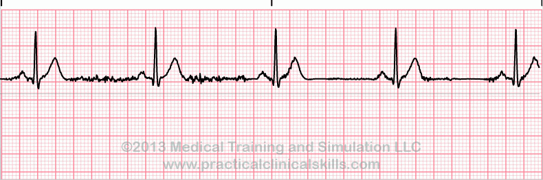 ecg rhythm strip for quiz