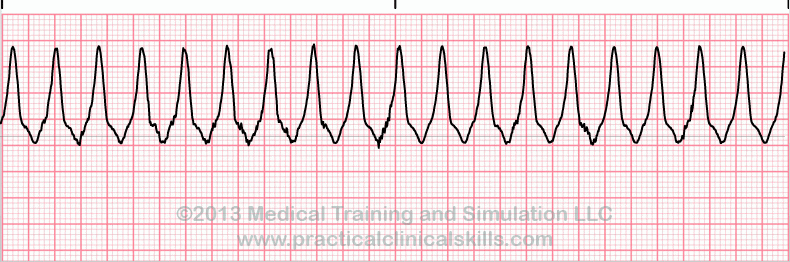 ecg rhythm strip for quiz