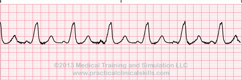 ecg rhythm strip for quiz