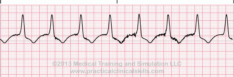 ecg rhythm strip for quiz