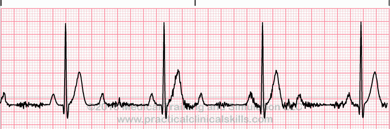 ecg rhythm strip for quiz