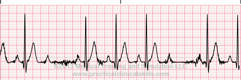 ECG Practice Drill