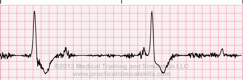 EKG Practice Drill