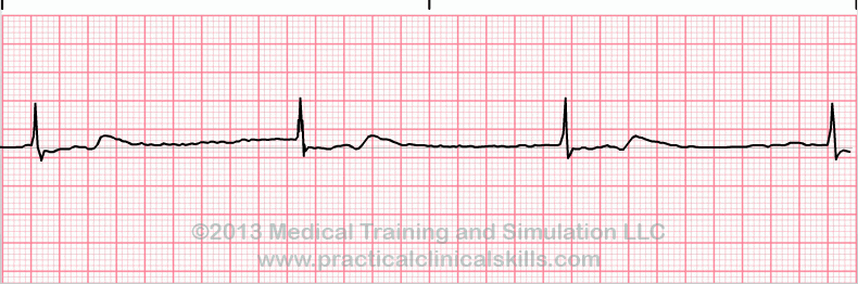 ecg rhythm strip for quiz