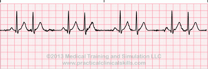 ecg rhythm strip for quiz