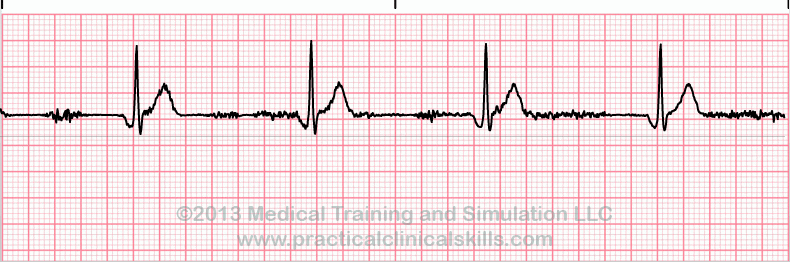 ecg rhythm strip for quiz