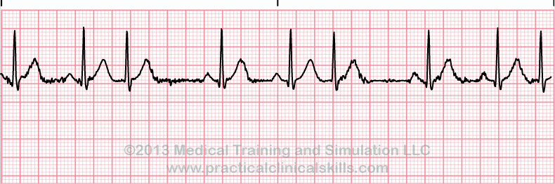 ecg rhythm strip for quiz