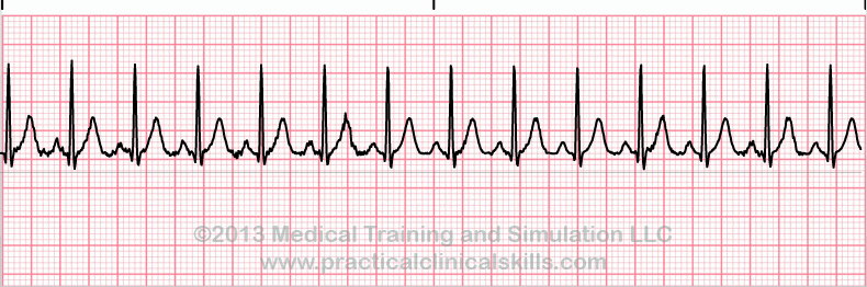 Essential EKGs for Nurses | Multiple Choice Graded Quiz