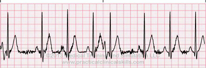 ecg rhythm strip for quiz