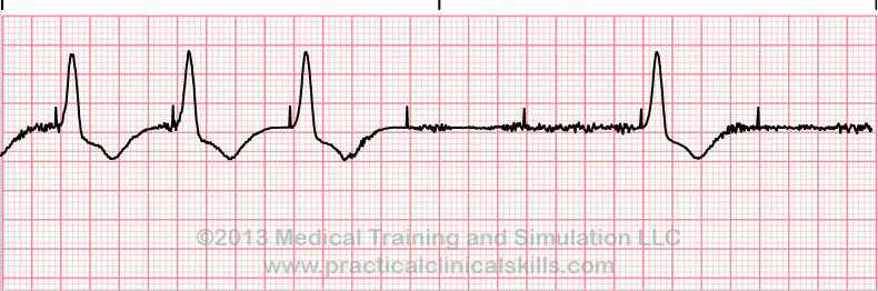 ecg rhythm strip for quiz