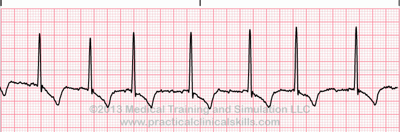 Atrial Fibrillation EKG tracing