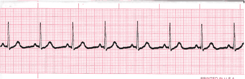 ecg rhythm strip for quiz