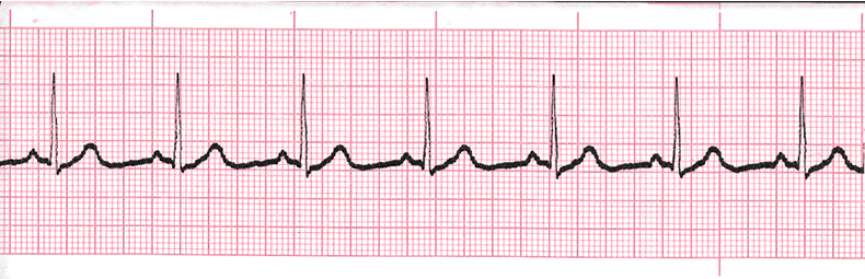 ecg rhythm strip for quiz