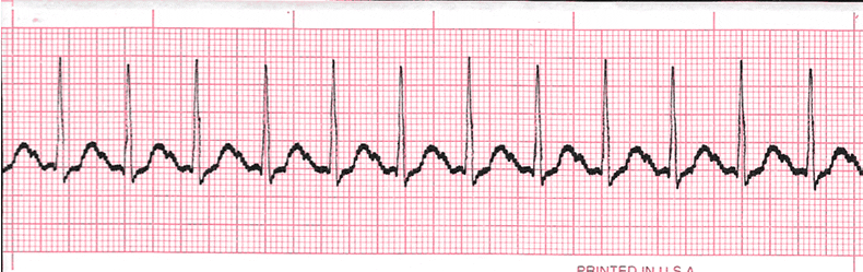 EKG Practice Drill