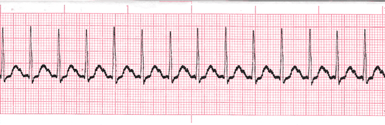 ecg rhythm strip for quiz