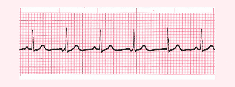 ecg rhythm strip for quiz