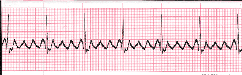 ecg rhythm strip for quiz