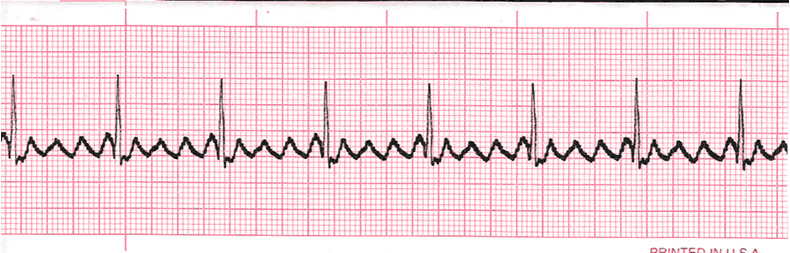 EKG Practice Drill