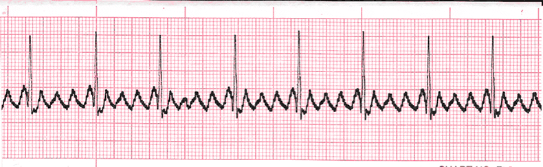 Comprehensive ECG Quiz | Multiple Choice Graded Quiz