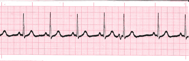 ecg rhythm strip for quiz