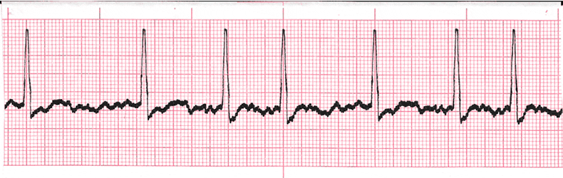 Multi Choice EKG Practice Drill