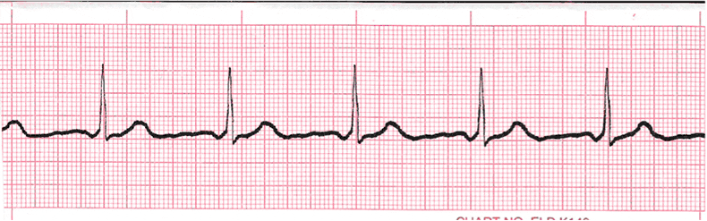 ecg rhythm strip for quiz