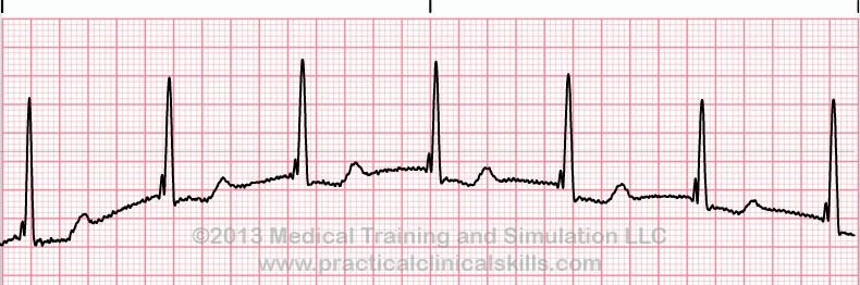 Accelerated Junctional Rhythm ECG tracing
