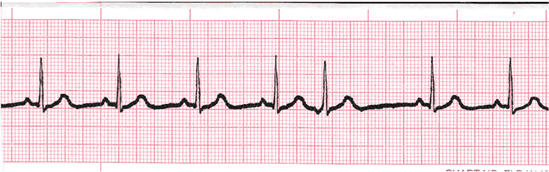 ecg rhythm strip for quiz
