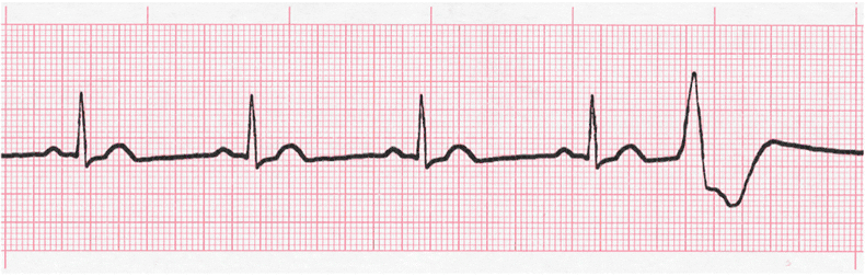 ecg rhythm strip for quiz