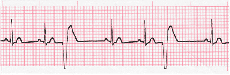 ECG Practice Drill