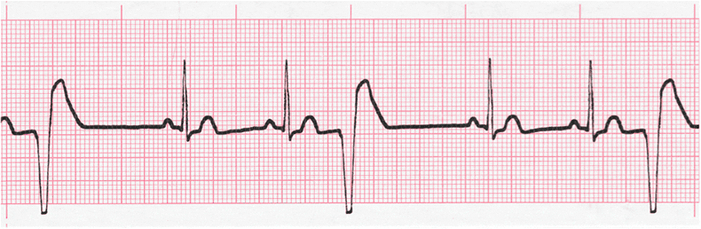 ecg rhythm strip for quiz