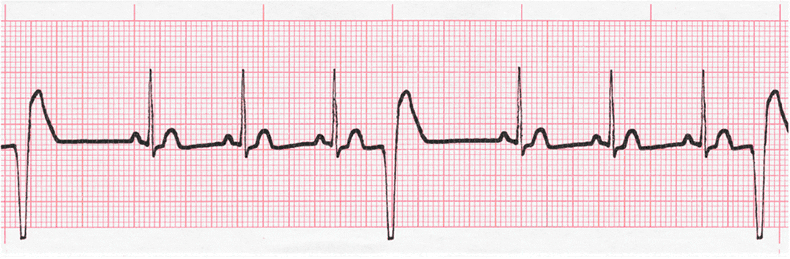 ecg rhythm strip for quiz