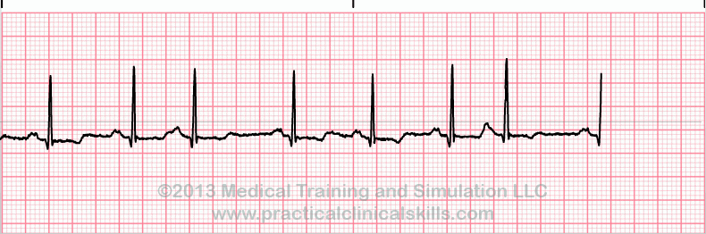 ecg rhythm strip for quiz