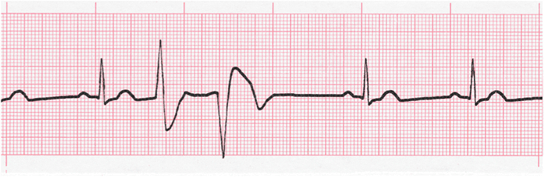 ecg rhythm strip for quiz