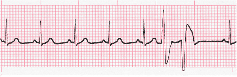 ecg rhythm strip for quiz
