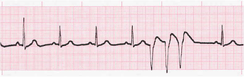 ECG Practice Drill