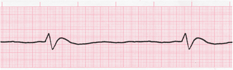 ECG Practice Drill