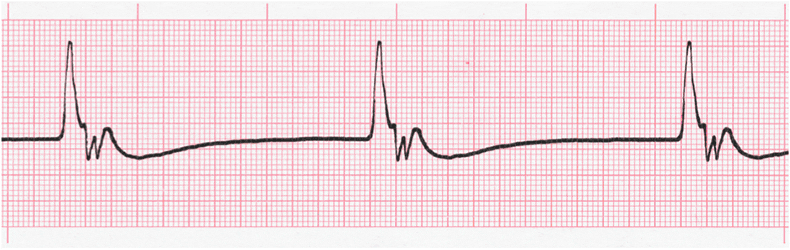 Comprehensive EKG Quiz | Multiple Choice Graded Quiz