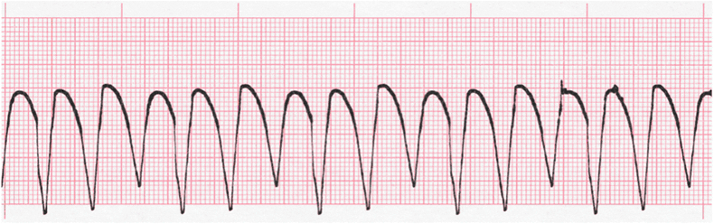 ecg rhythm strip for quiz